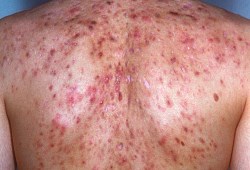 Steroids acne on shoulders