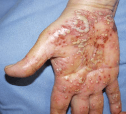 Picture of Viral Skin Diseases and Problems - Warts (Human ...