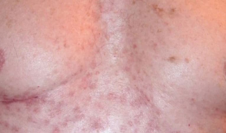 How to Get Rid of Chest Acne