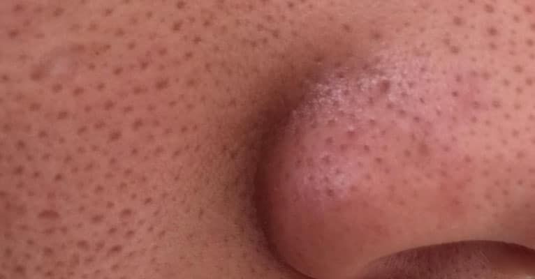 acne and pores
