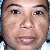 A Unique Acne Treatment for Black Skin?