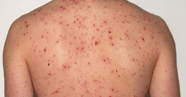 Image result for pimples on back