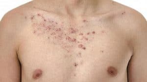 Chest acne caused by friction