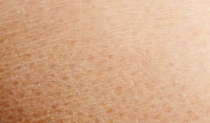 Dry skin prone to acne
