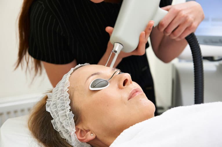 laser treatment for acne