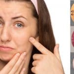 Accutane Isotretinoin for Acne