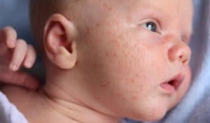 Benzoyl Peroxide for Baby Acne