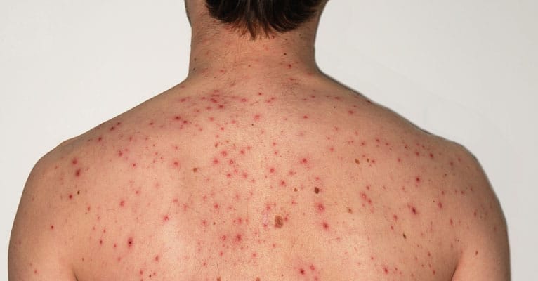 Severe body acne