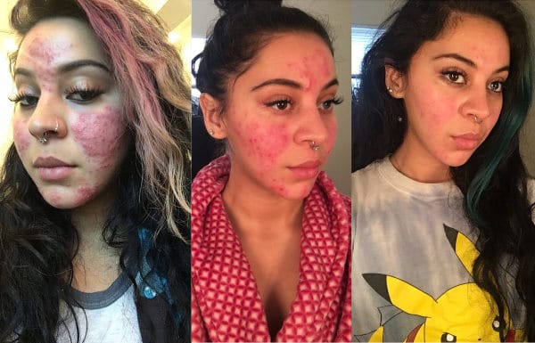 exposed skincare before and after