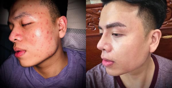 acne treatment before and after with exposed skincare